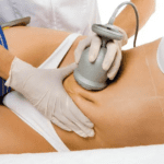 Aprovecha los beneficios de la cavitación abdominal