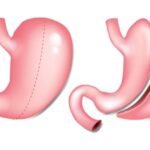Aprovechando la manga gástrica: transforma tu salud