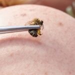 Los increíbles beneficios de las picaduras de abejas
