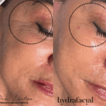 Maximiza tu belleza con Hydrafacial