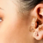 Beneficios de la acupuntura para bajar de peso