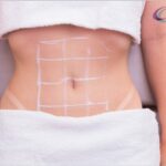 Beneficios de la carboxiterapia en el cuerpo