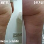 Beneficios de la carboxiterapia en las piernas