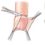 Beneficios de la circuncisión en bebés