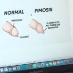 Beneficios de la circuncisión en la edad adulta