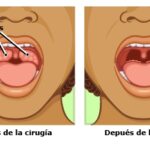 Beneficios de la cirugía para quitar las amígdalas