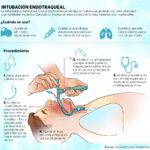Beneficios de la intubación en pacientes