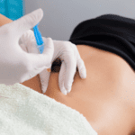 Beneficios de la mesoterapia