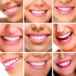 Beneficios de las carillas: sonrisas perfectas