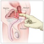 Beneficios del masaje de próstata: bienestar y salud para todo hombre