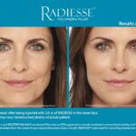 Beneficios infinitos de Radiesse