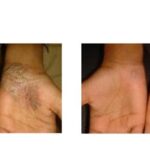 Brilla con los beneficios de los rayos UVA para tratar la psoriasis