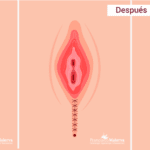 Brillando con los beneficios de la perineoplastia