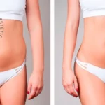 Mejora tu figura: los sorprendentes beneficios de la mesoterapia abdominal