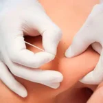 Mejora tu salud con la punción seca