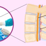 Mejoras con la epidural