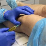 Plasma en la rodilla: ventajas y beneficios