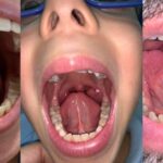 Potencia tu salud con la frenectomía