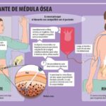 Revitaliza tu salud con un trasplante de médula ósea