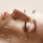Rostro rejuvenecido: los beneficios de la acupuntura facial