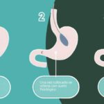 Salud en equilibrio: beneficios del balón gástrico