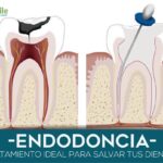 Sonríe sin dolor: los beneficios de la endodoncia
