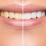 Sonríe sin preocupaciones: beneficios del blanqueamiento dental