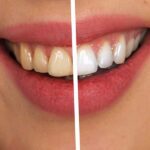 Sonrisa saludable: los beneficios de limpiar dentalmente