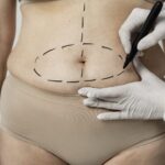 Transforma tu cuerpo: los beneficios de la abdominoplastia