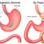 Vive mejor: beneficios del bypass gástrico